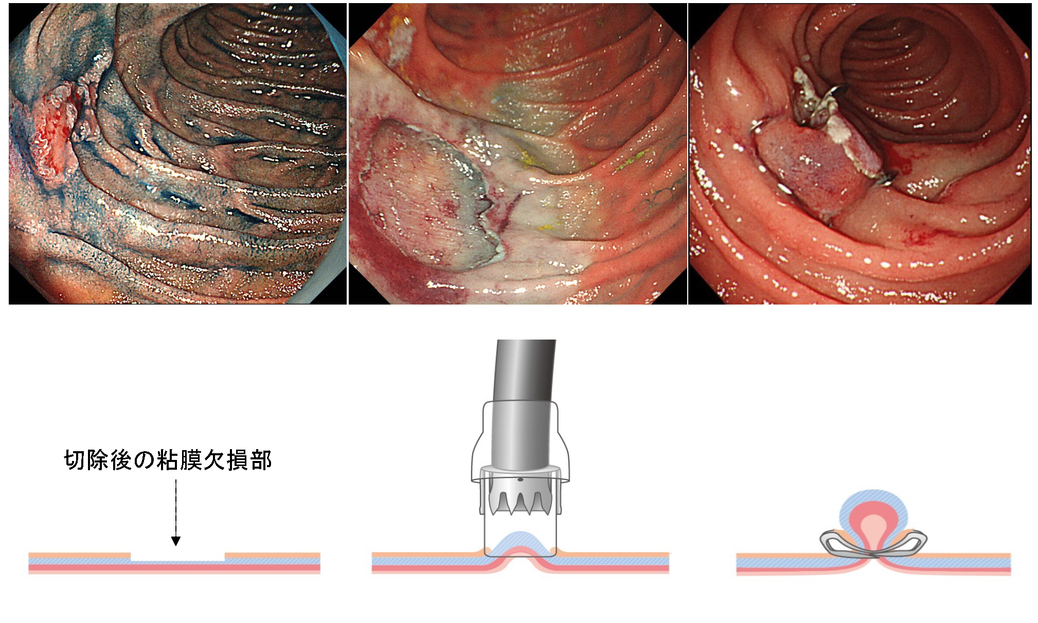消化管グループの内視鏡治療の特徴 | 埼玉医科大学国際医療センター